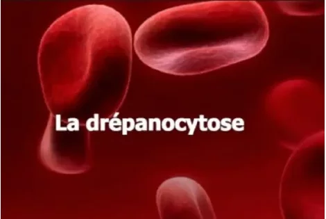 Drépanocytose : voici le remède magique pour soulager les personnes atteintes de cette maladie