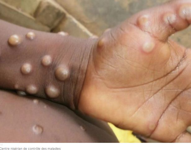 mpox-3.jpg